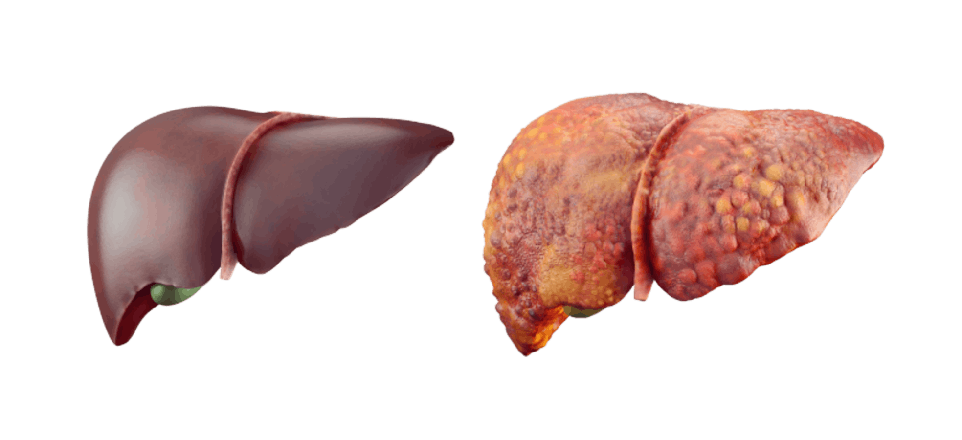 Healthy vs. Damaged Liver
