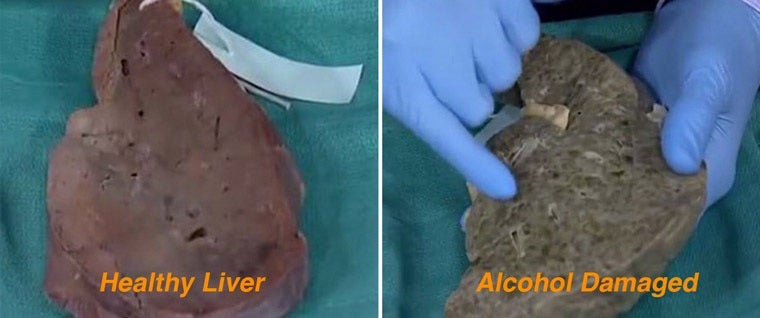 Liver comparison